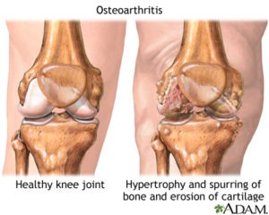 knee Osteoarthritis