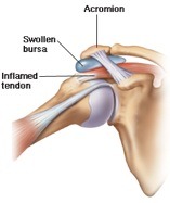 shoulder bursitis